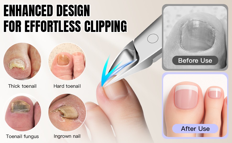 Toenail Clippers for Thick Nails – Ingrown Toenail Removal Kit – 12Pcs