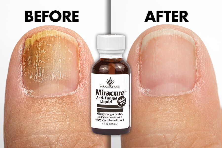 Miracure Anti-Fungal Treatment 1 ounce bottle with 10 Toe Separators and Brush