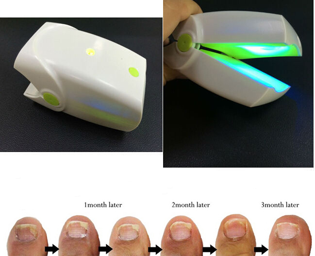 Rechargeable portable nail fungus laser therapy toe nail laser toenail fungus CE