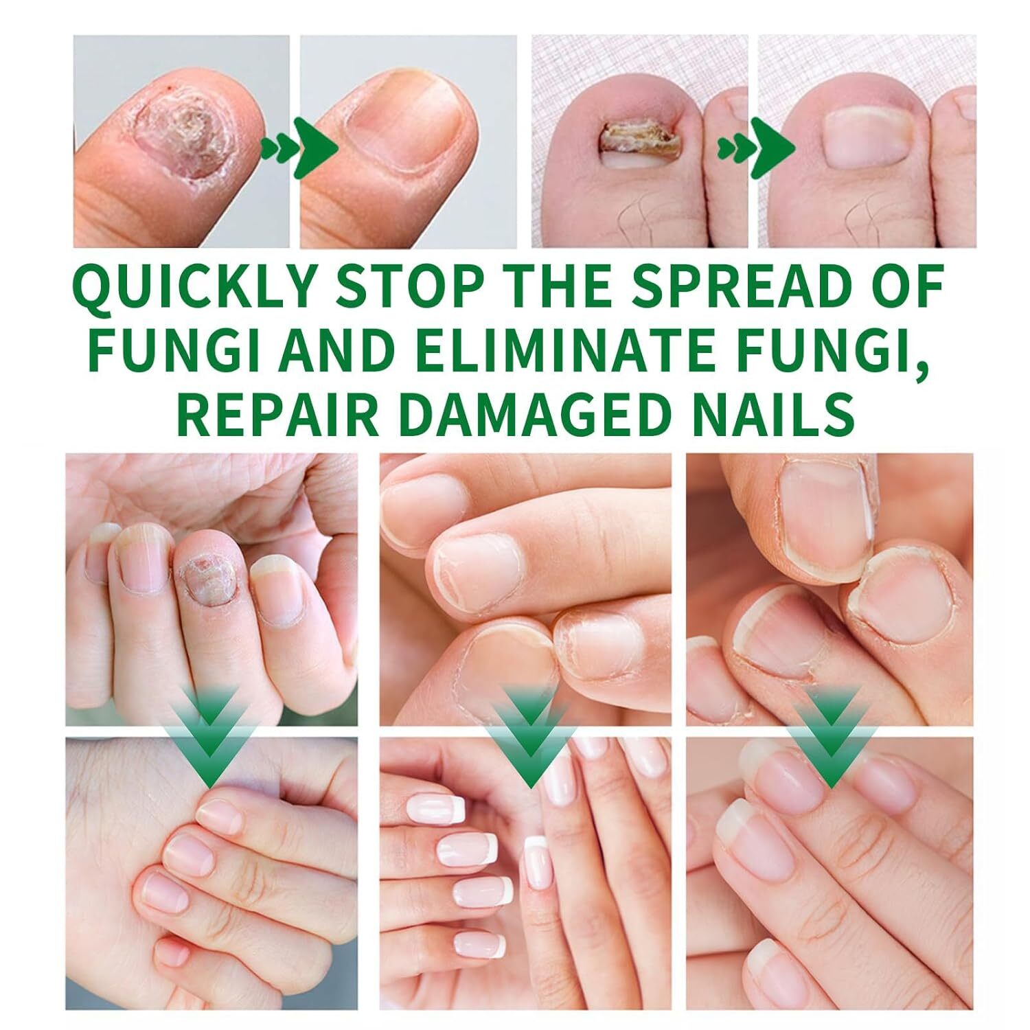 Nutraboost Nail Fungus Treatment Gel, Nail Fungus, Fungus Cream 2025 NEW （1PC）