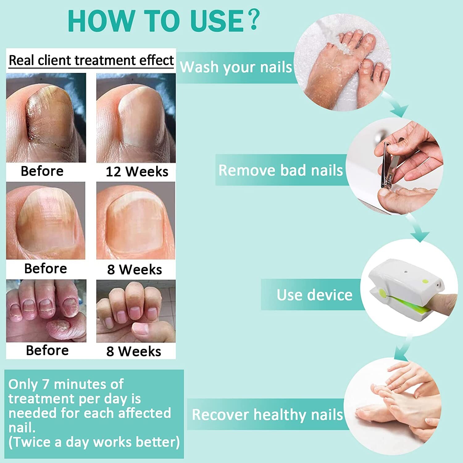 Antifungal Nail Fungus Treatment Blue Light Therapy Device Remove Fungal Fungi