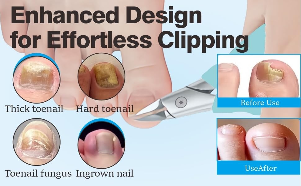 Toenail Clippers for Thick Nails – Ingrown Toenail Removal Kit – 12Pcs