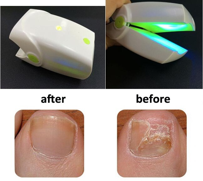 NEW Toenail Fungus Laser Device Toenail Fungal Onychomycosis Infection Fungicure
