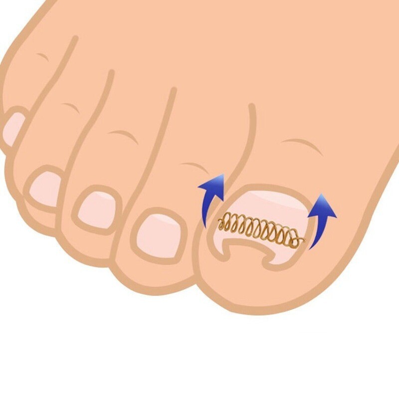Toenail Correction Tool 12pcs/set Ingrown Toe Nail Fixer Pedicure 2024 NEW