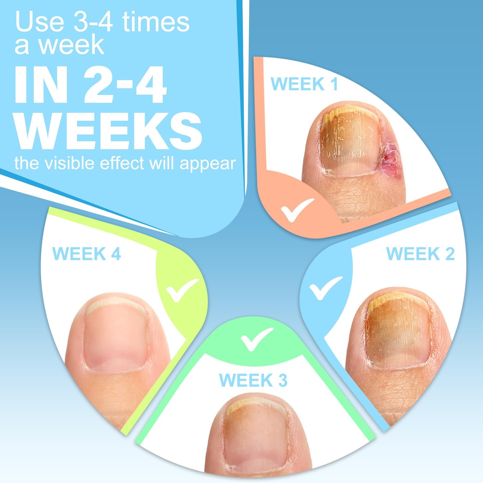 Ingrown Toenail Treatment w/Ingrown Toenail Drops Reliever & Softener,Double …