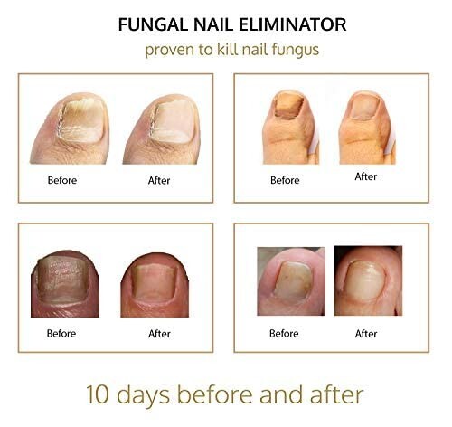 Antifungal Nail Fungus Treatment Blue Light Therapy Device Remove Fungal Fungi