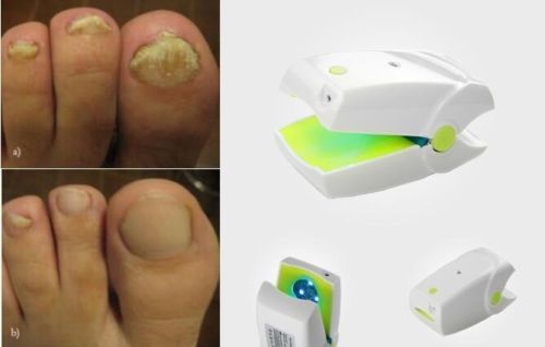NEW Toenail Fungus Laser Device Toenail Fungal Onychomycosis Infection Fungicure