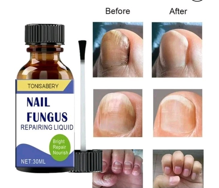 Nail Fungus Treatment For Toe and Finger Nails 30 ml
