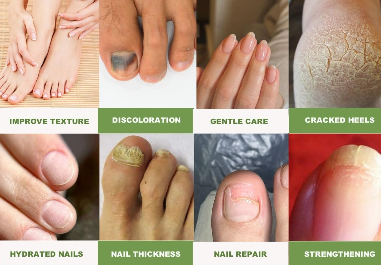 Urea Nail Gel – Strengthens & Softens Nails, Quick-Dry Formula for Damaged nails
