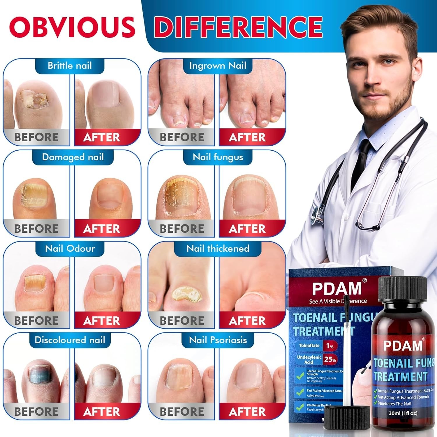PDAM Toenail Fungus Treatment Extra Strength 1 Fl Oz/30ml 7 DAYS REMEDY Fast-Act
