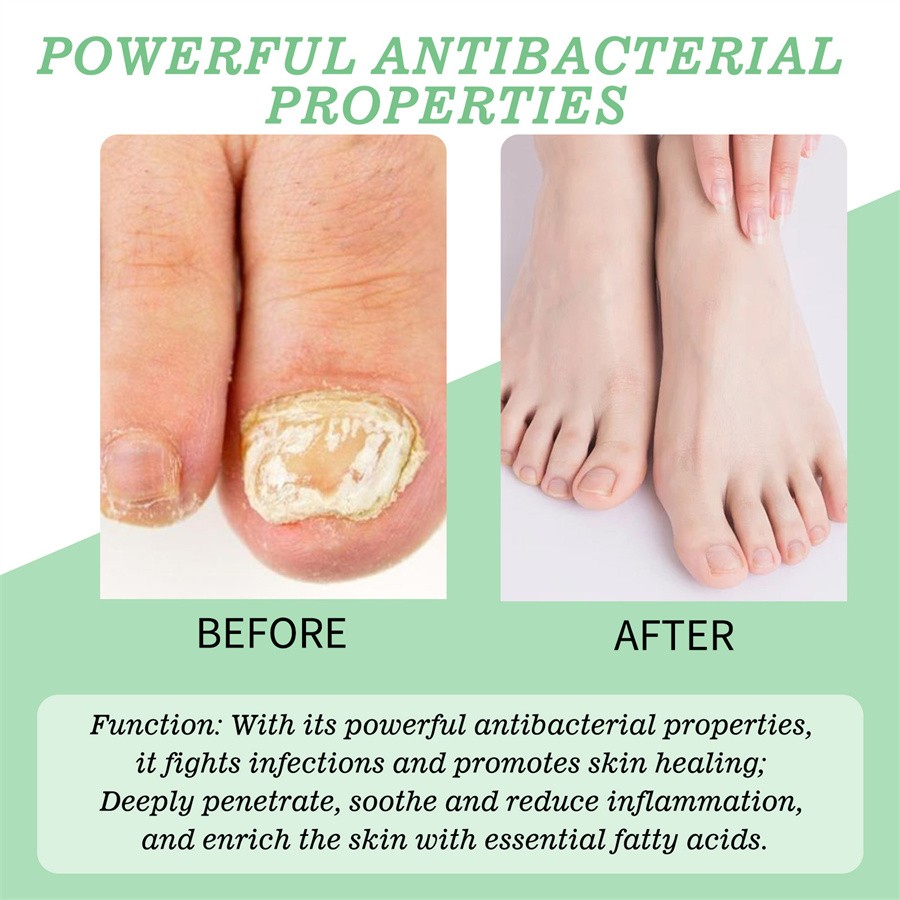 Nutraboost Nail Fungus Treatment Gel, Nail Fungus, Fungus Cream 2025 NEW （1PC）