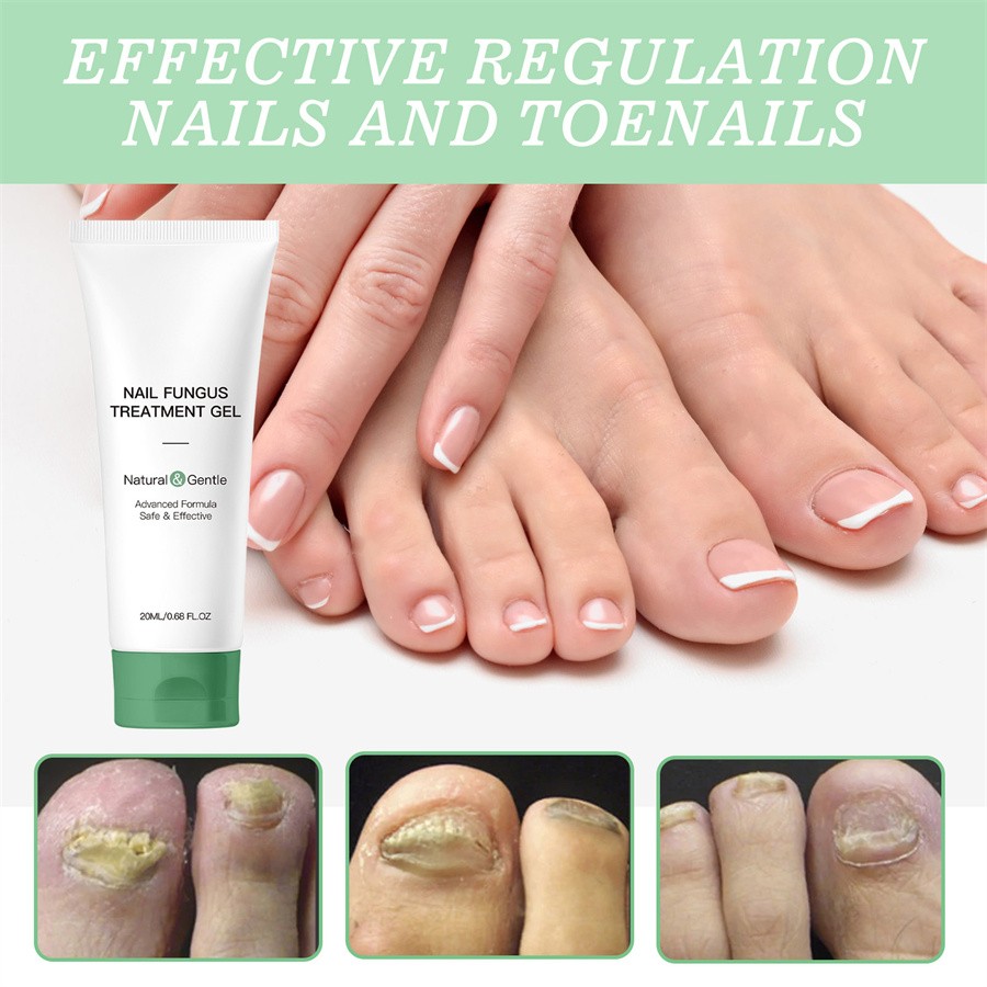 Nutraboost Nail Fungus Treatment Gel, Nail Fungus, Fungus Cream 2025 NEW （1PC）