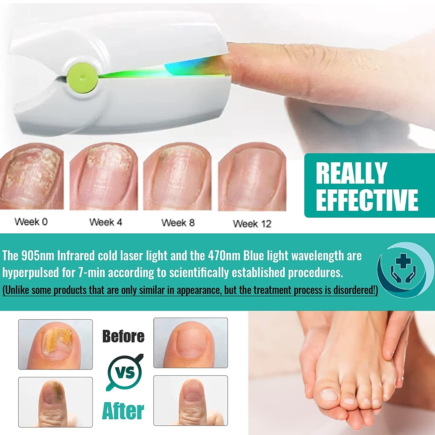 Antifungal Nail Fungus Treatment Blue Light Therapy Device Remove Fungal Fungi