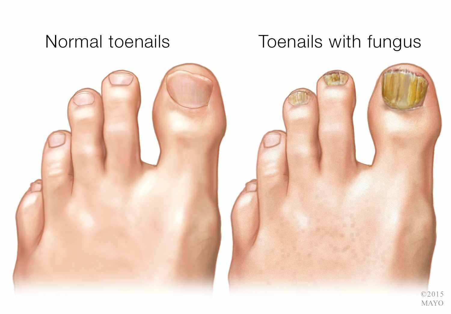ORIUNDO natural life / Nail Fungus Away (Quita Hongos para Uñas)