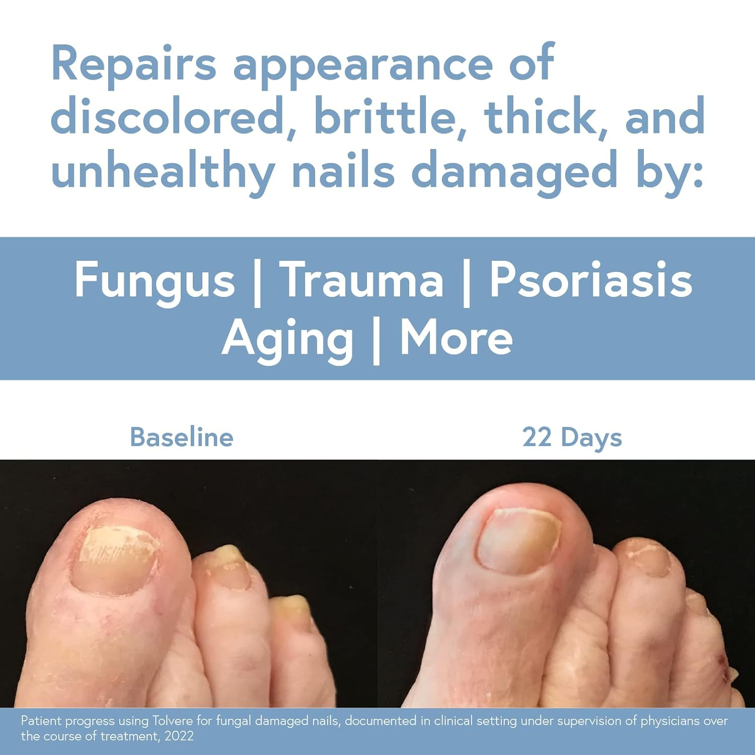 Tolvere Nail Renewal Solution, Rapidly Improve Appearance of Discolored, Brittle