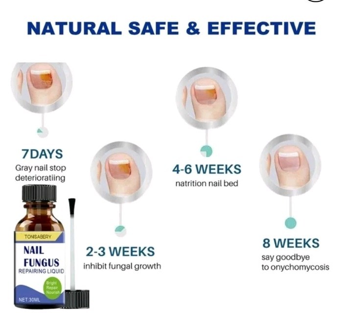 Nail Fungus Treatment For Toe and Finger Nails 30 ml