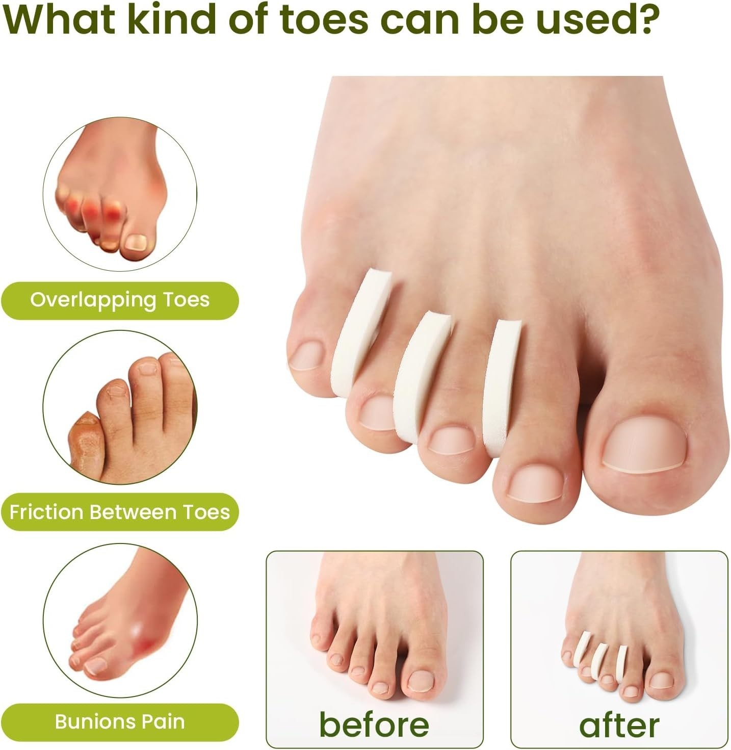 50 Pack Foam Toe Separators – Correct Overlapping Toes and Reduce Friction – …
