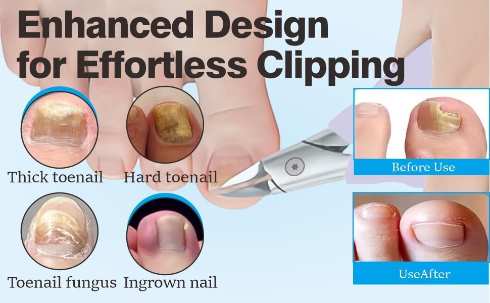 Toenail Clippers for Thick Nails – Ingrown Toenail Removal Kit – 12Pcs