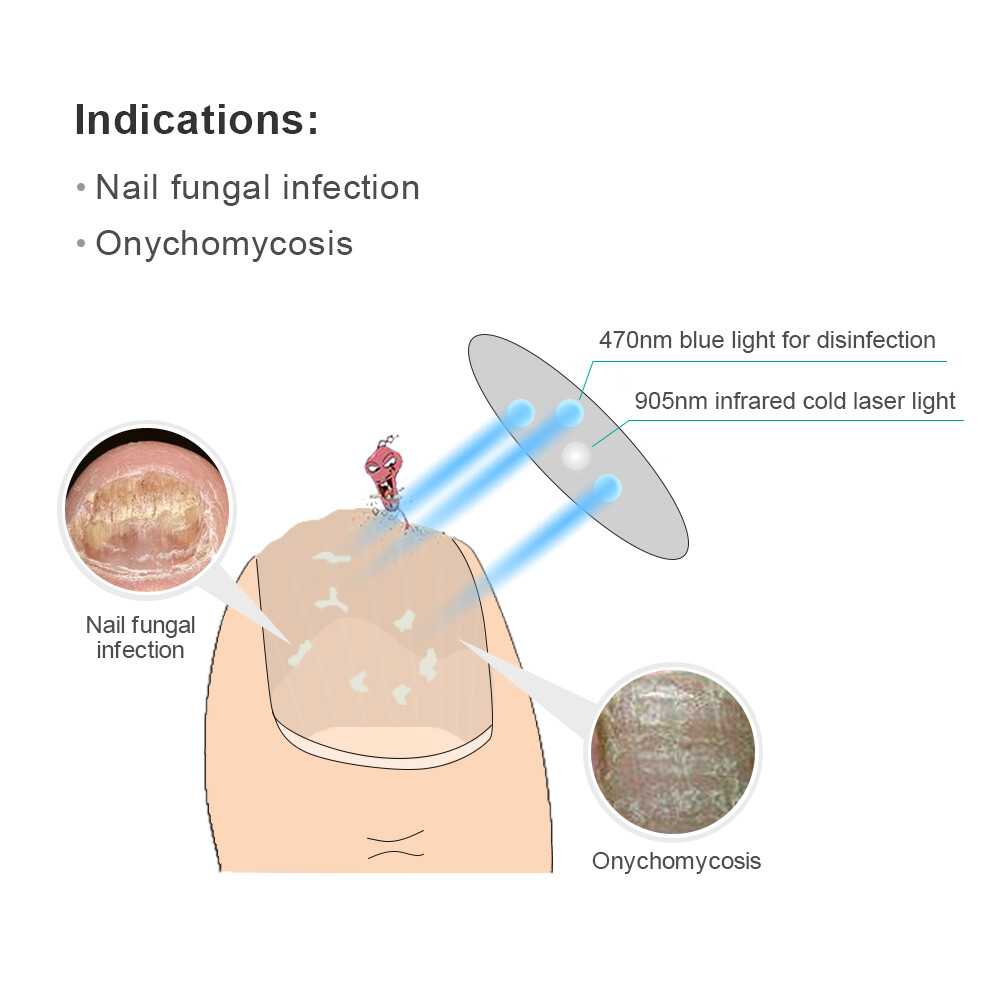 Fungal Nail Treatment Toenail Fungus Laser Device Anti Nail Fungal Infection US