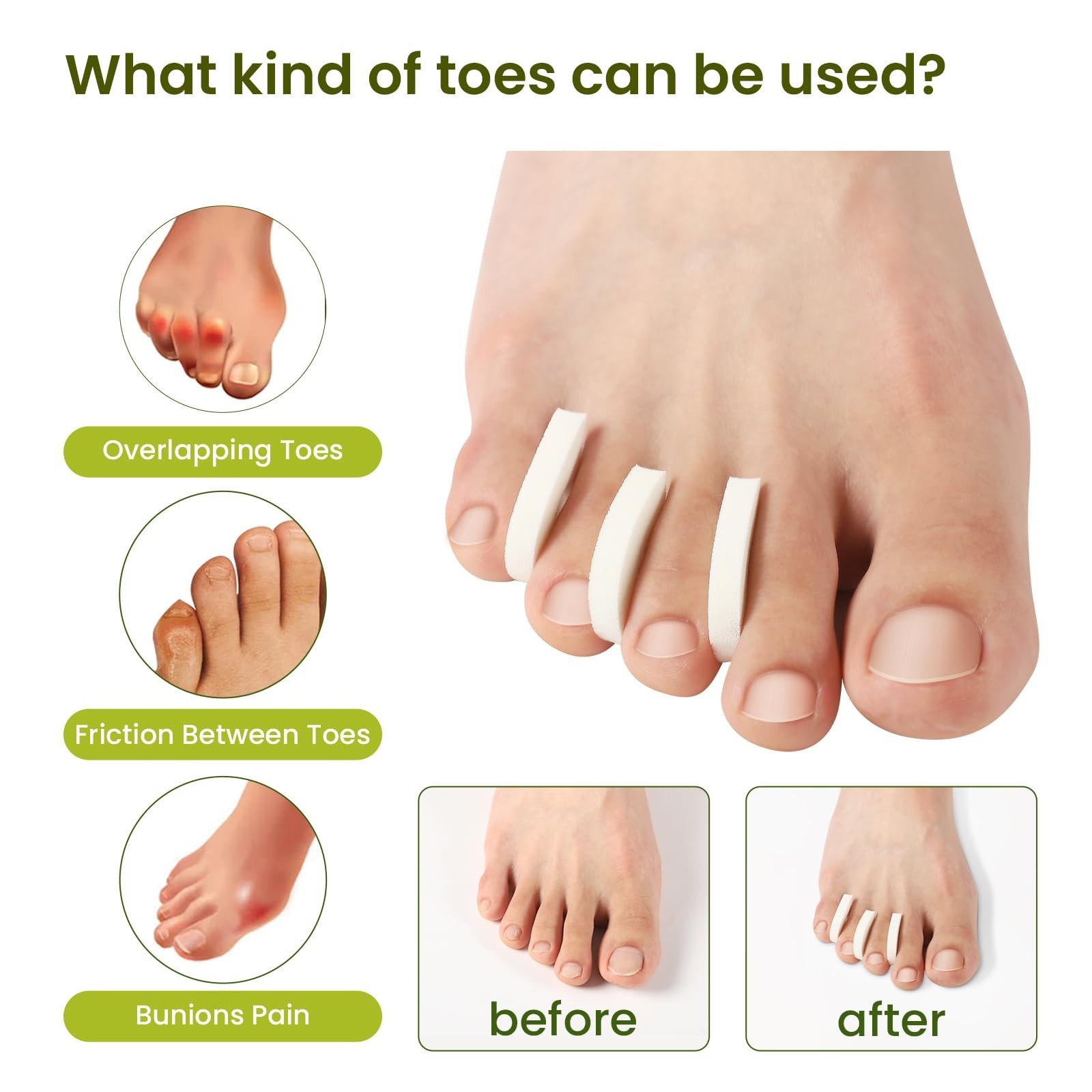 Bukihome 50 Pack Foam Toe Separators – Correct Overlapping Toes and Reduce Fr…
