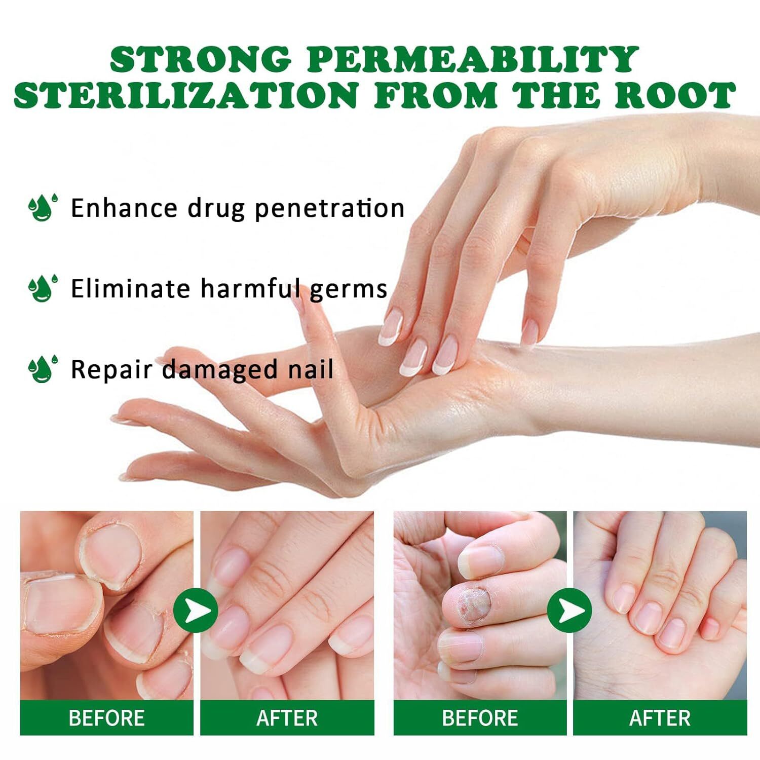 Nutraboost Nail Fungus Treatment Gel, Nail Fungus, Fungus Cream 2025 NEW （1PC）