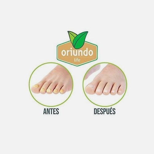 Oriundo Nail Fungus Treatment | 0.5 oz | 5 Pack | $19.90 per bottle