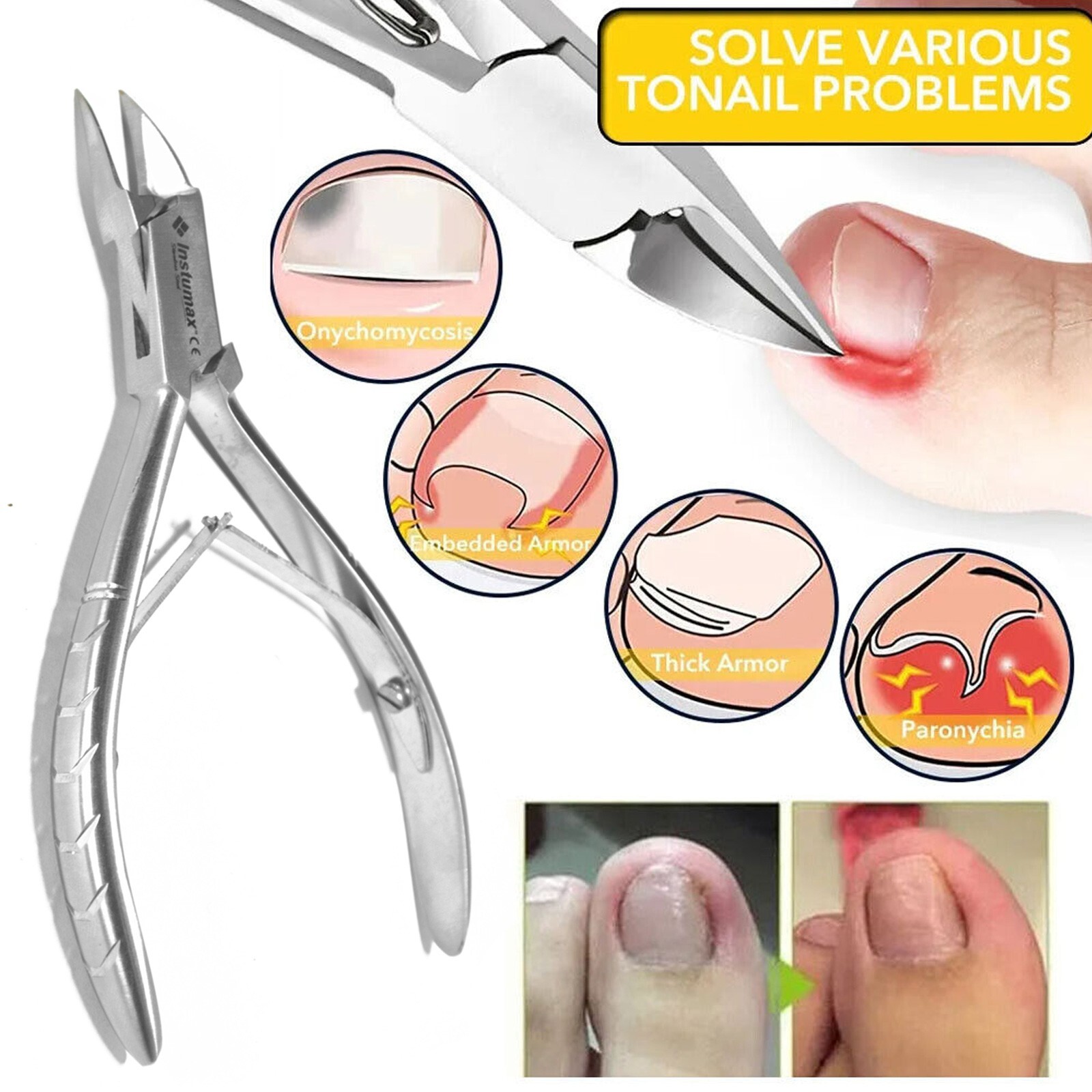 TOE NAIL CLIPPERS SET PROFESSIONAL HEAVY DUTY PODIATRIST INSTRUMENTS CHIROPODY