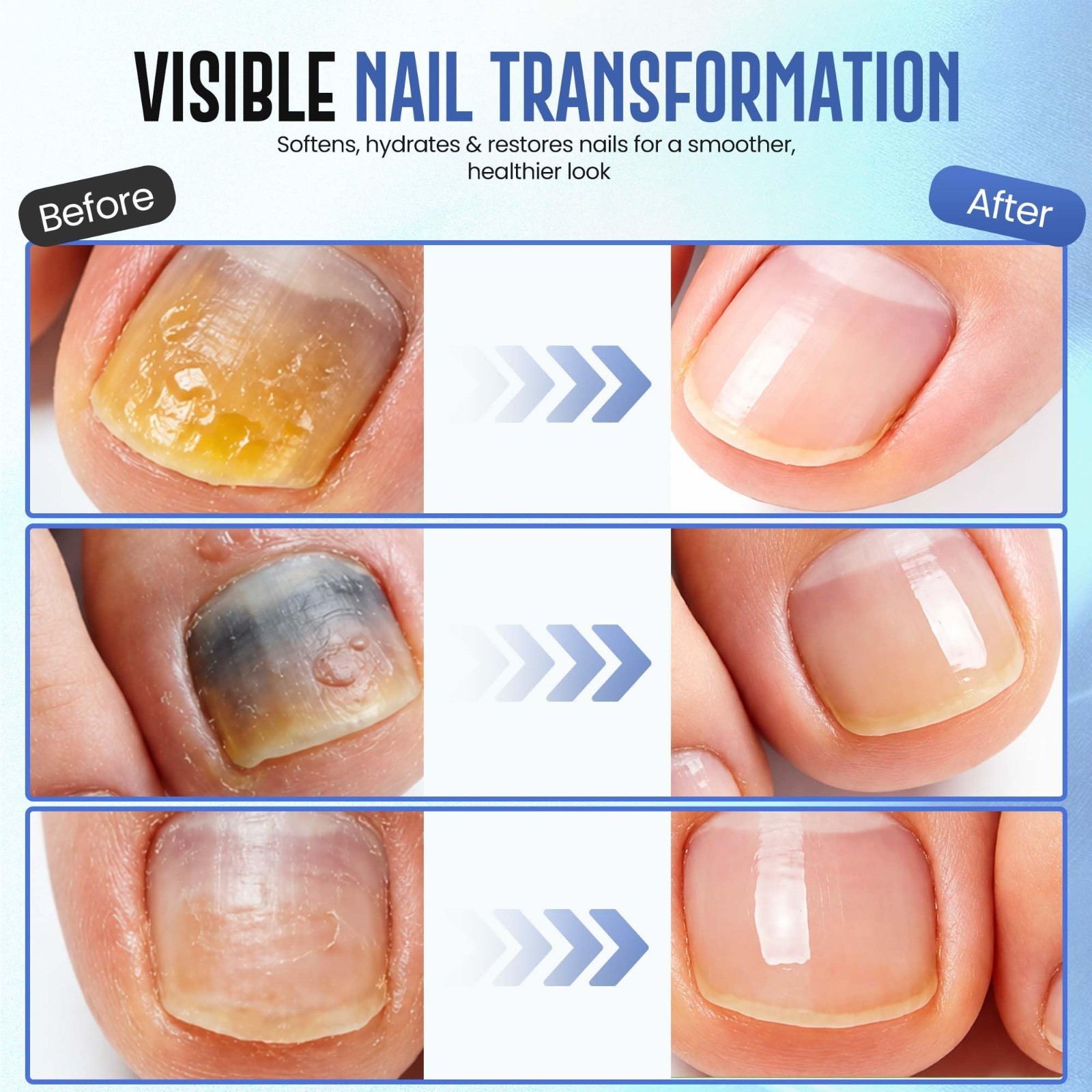 50% Urea Nail Gel for Thick Toenails & Calluses – Softens, Exfoliates, Quick-Dry