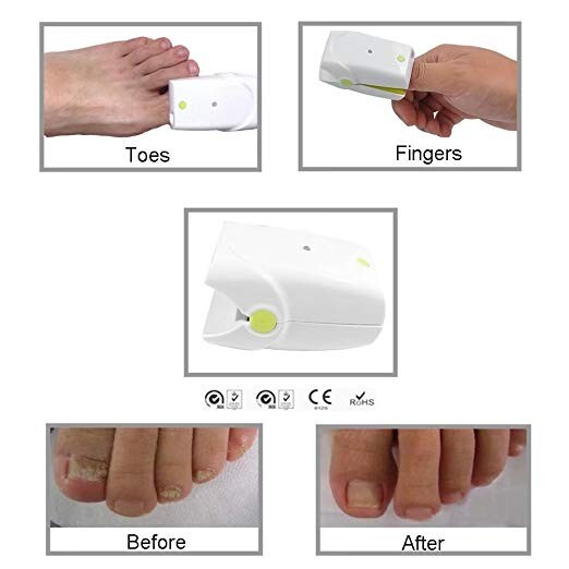 NEW Toenail Fungus Laser Device Toenail Fungal Onychomycosis Infection Fungicure