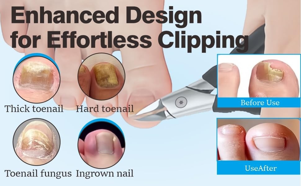 Toenail Clippers for Thick Nails – Ingrown Toenail Removal Kit – 12Pcs