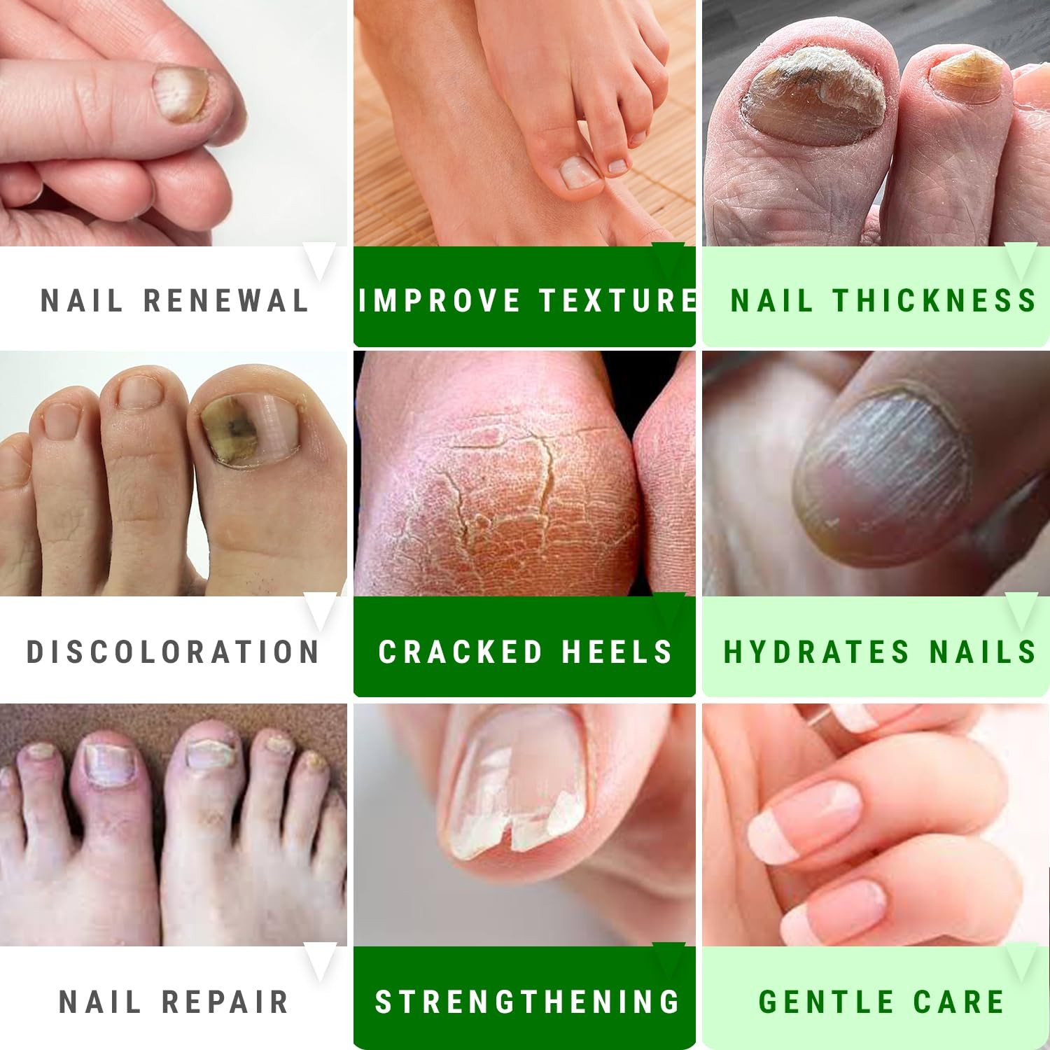 Urea Nail Gel – Softens Cracked Heel 1 Fl Oz (Pack of 1), Green 40