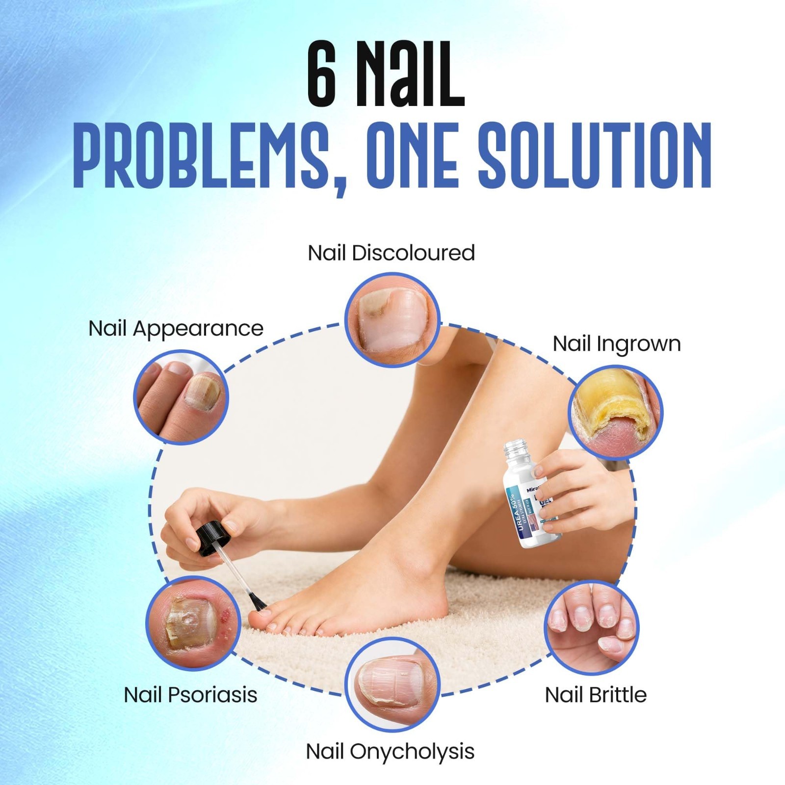 50% Urea Nail Gel for Thick Toenails & Calluses – Softens, Exfoliates, Quick-Dry