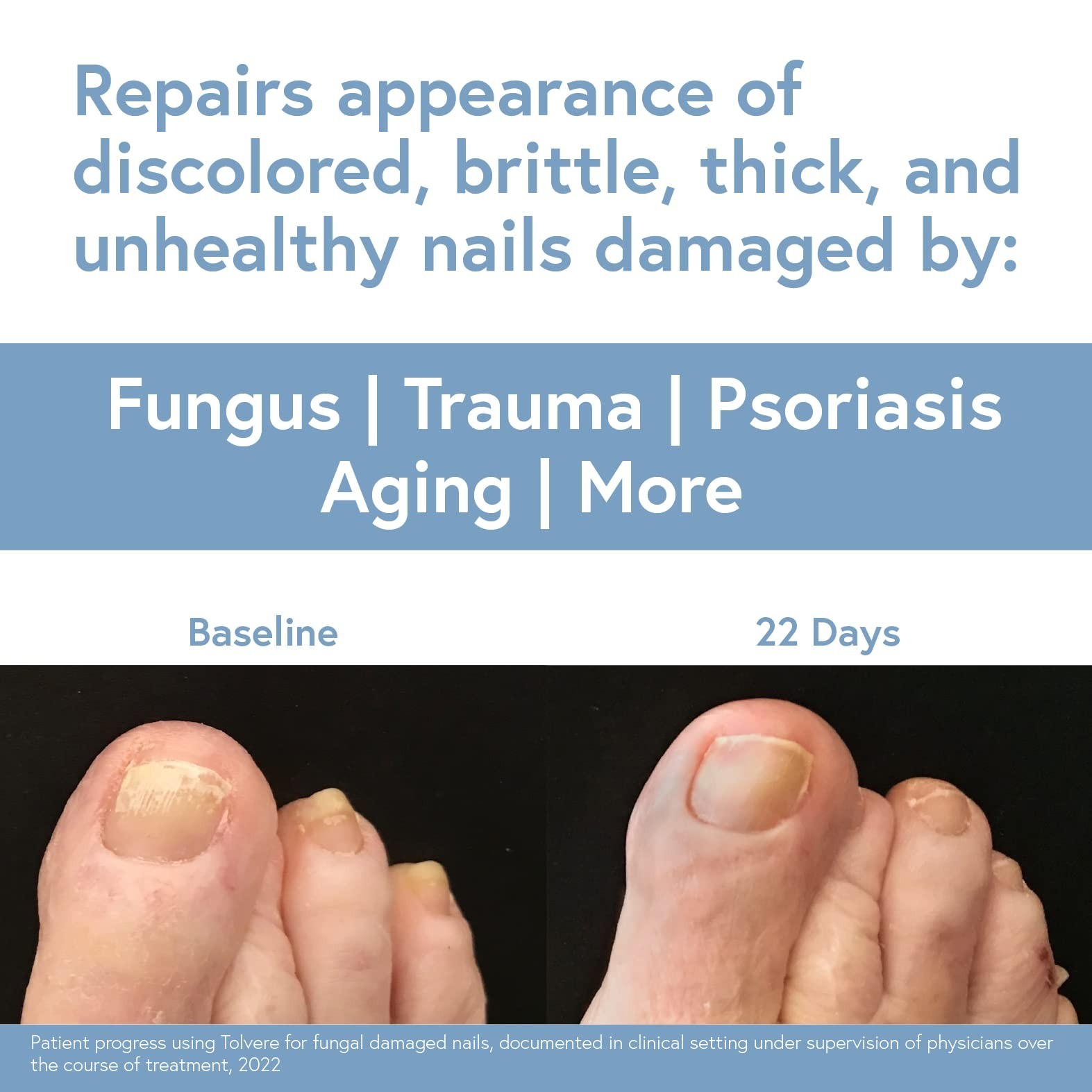 Tolvere Nail Renewal Solution, Rapidly Improve Appearance of Discolored, Brit…