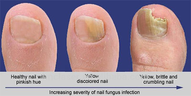 Rechargeable portable nail fungus laser therapy toe nail laser toenail fungus CE